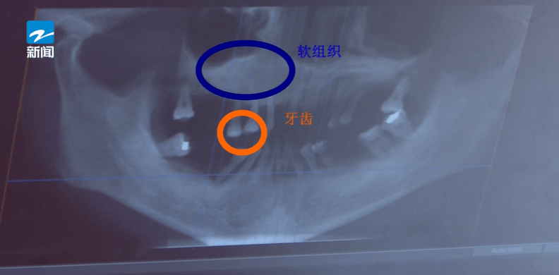 皇冠信用盘登123出租_44岁女子牙齿掉光皇冠信用盘登123出租!只因这个很多人都忽视的“小问题”……