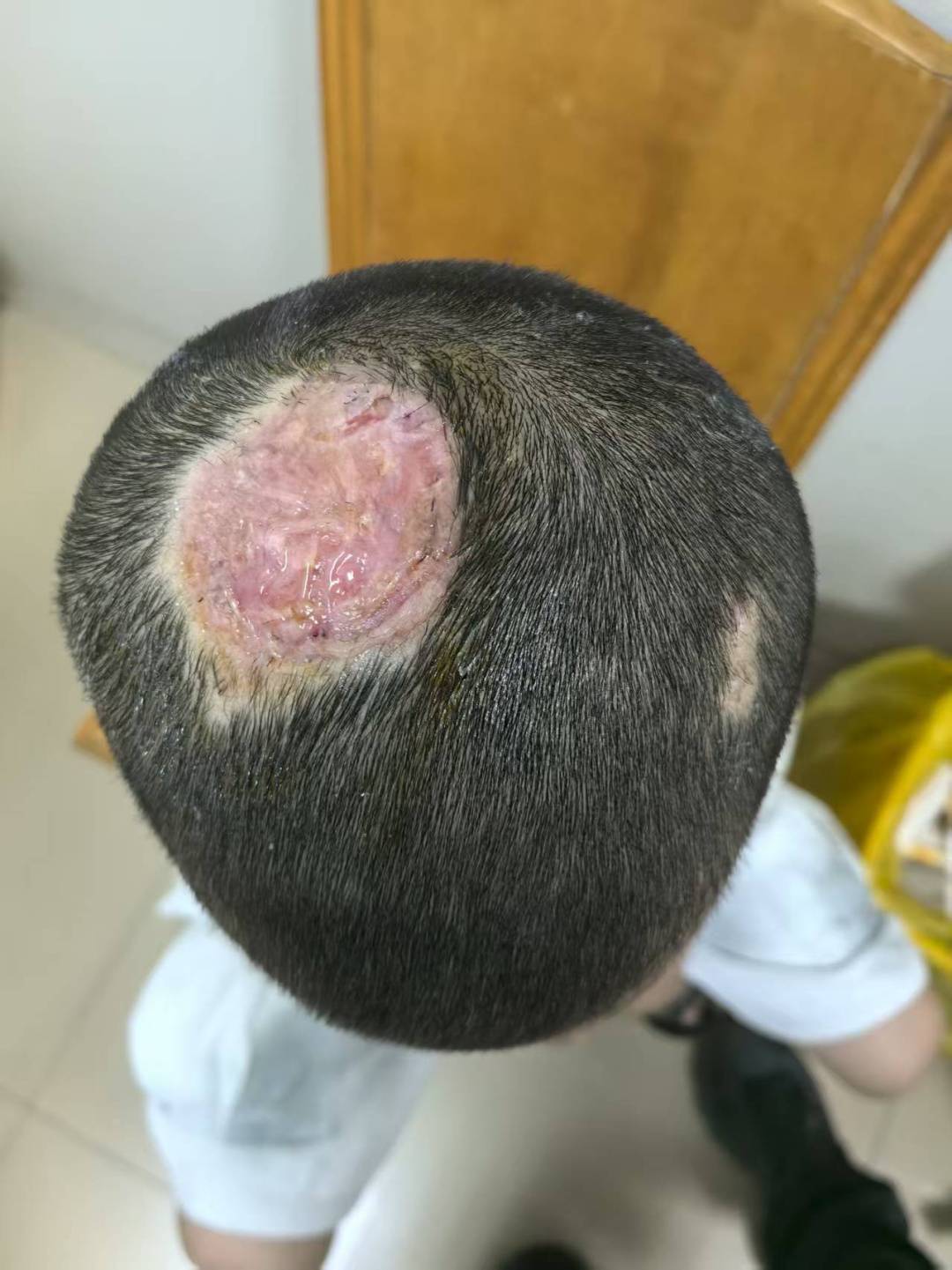 皇冠信用盘APP下载_6岁小男孩领养了只兔子皇冠信用盘APP下载,没想到头上长出脓包,反复溃烂,竟导致永久秃发!