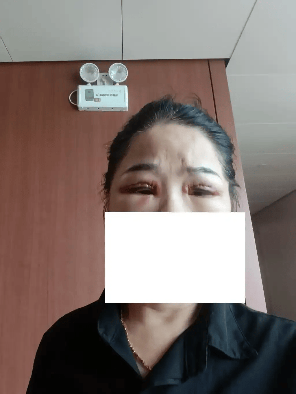 世界杯皇冠信用网代理_从600多元变成5万元世界杯皇冠信用网代理,广东57岁保洁员掏空积蓄做医美,双眼皮手术后眼睛红痛、视物模糊,当事人:销售像人贩子一样围着我;机构拒绝回应